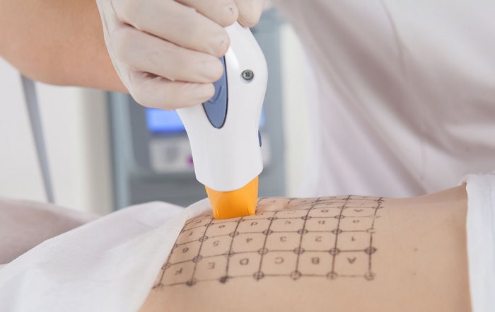 Термаж для подтяжки овала лица