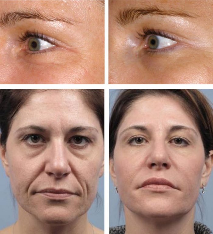 Плазмолифтинг омоложение