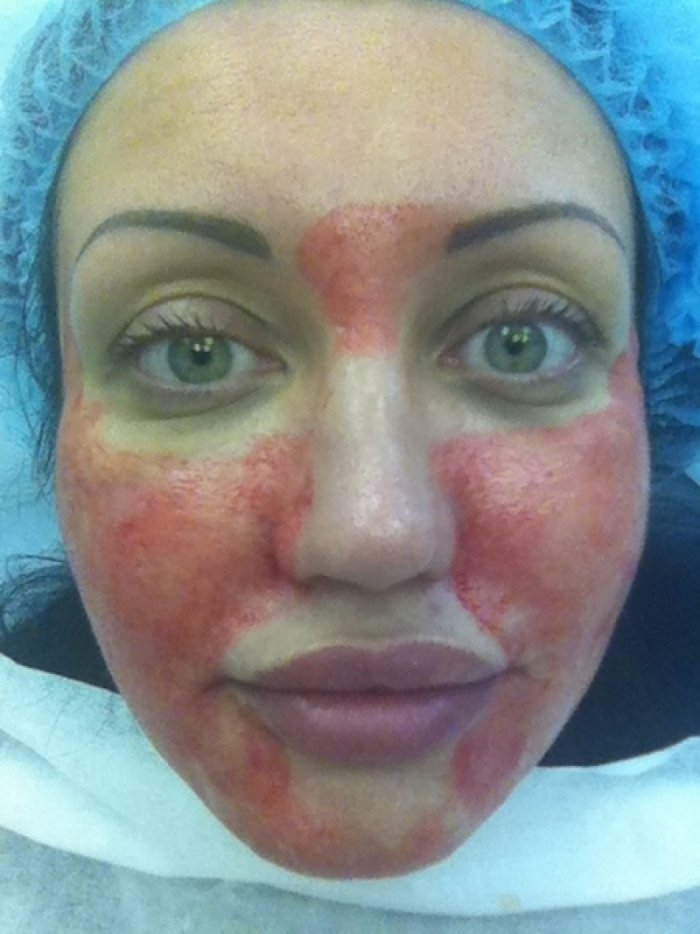 Плазмолифтинг омоложение