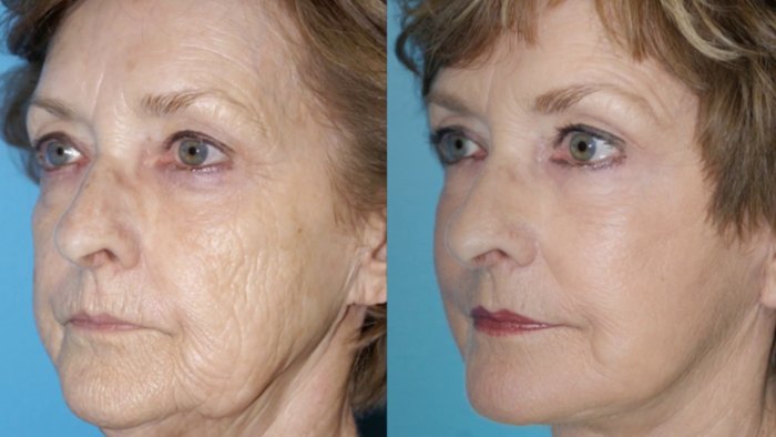 Плазмолифтинг лица до и после