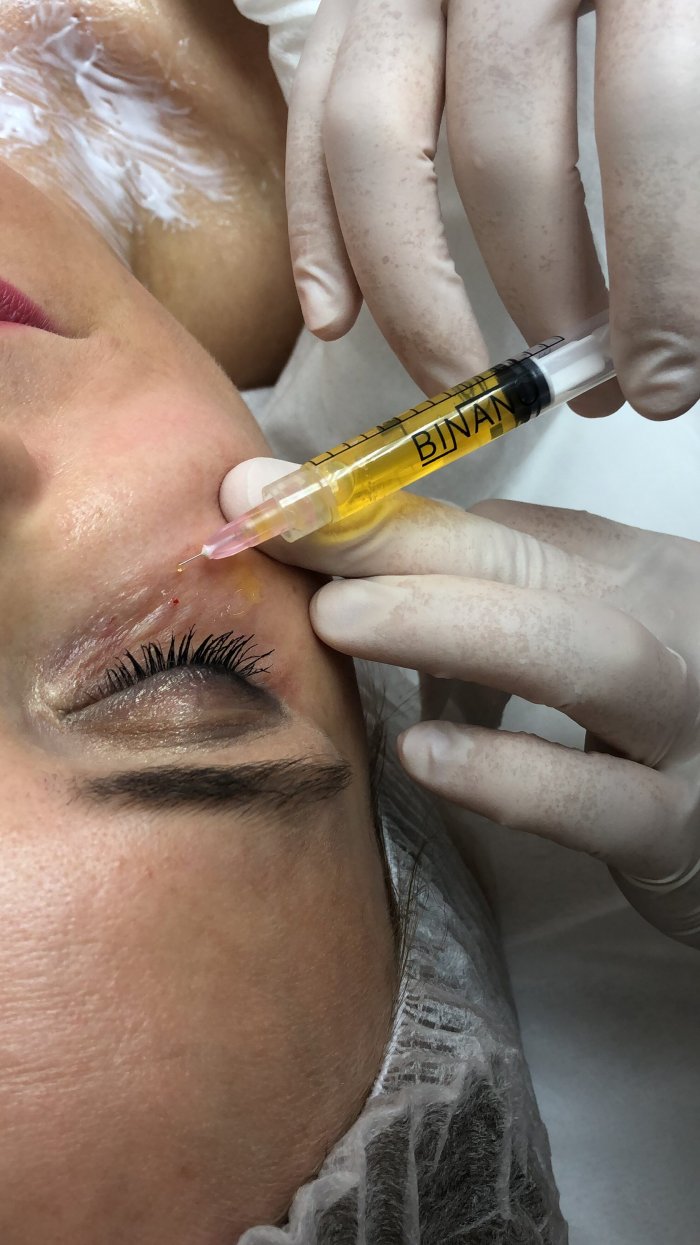 Плазма в косметологии для лица