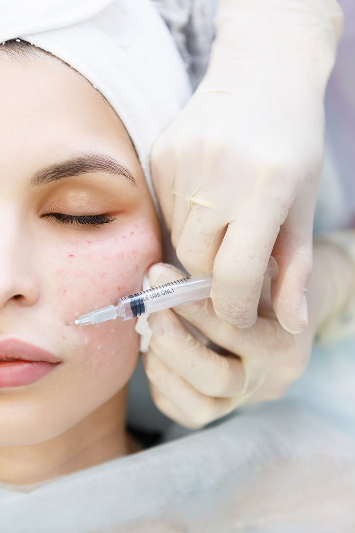 Плазмотерапия лица до и после