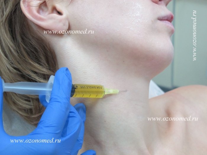 Плазмолифтинг процедура