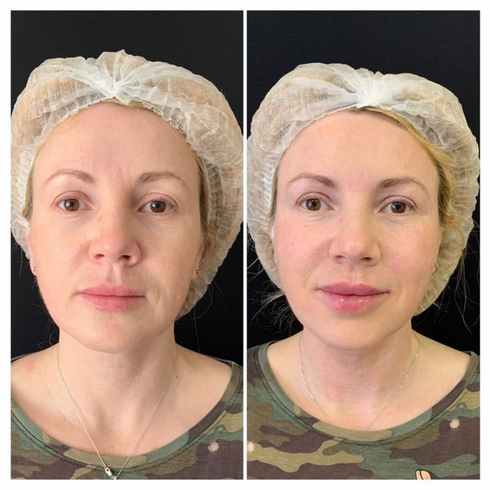 Плазмолифтинг женские зоны