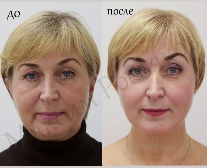 Омоложение лица плазмолифтинг