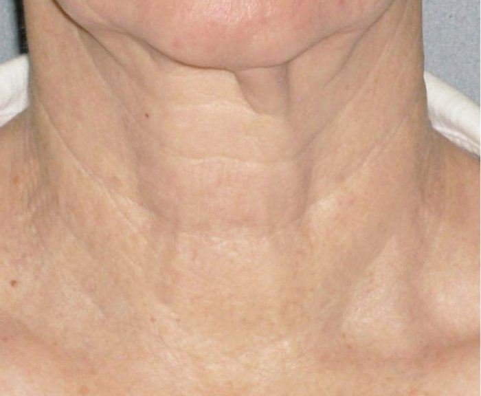 Плазмолифтинг лица точки