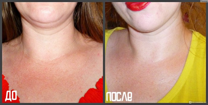 Биоревитализация лица и шеи