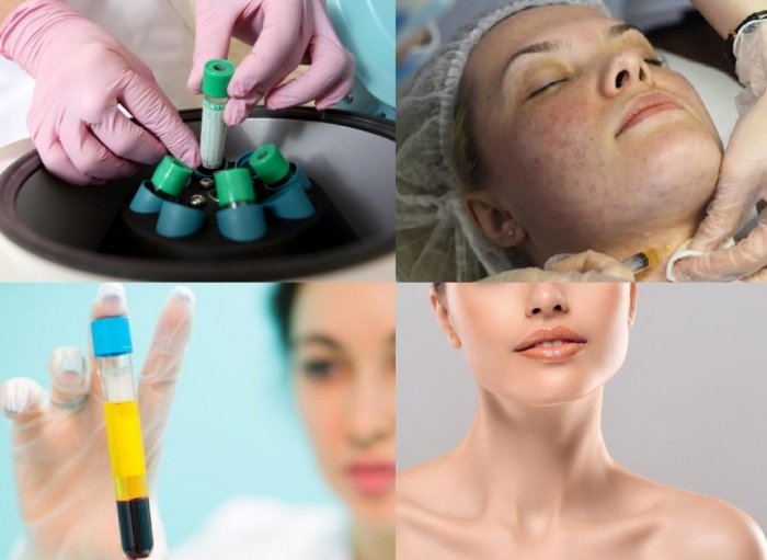 Мезотерапия шеи до и после