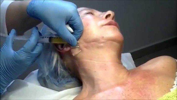 Биоревитализация зоны декольте до и после