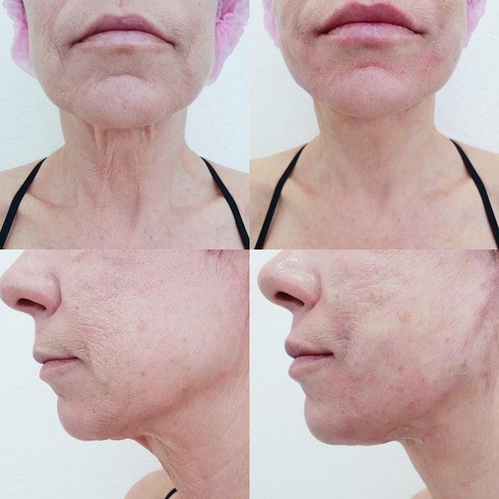 Плазмолифтинг шеи и декольте