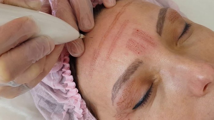 Биоревитализация шеи и декольте до и после