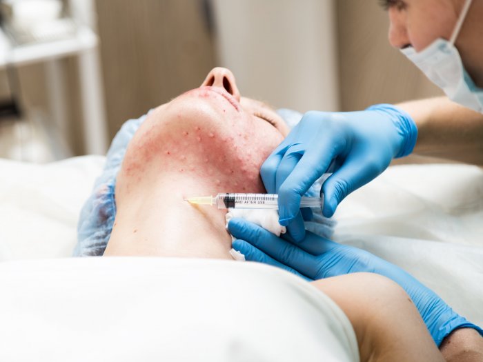 Плазмолифтинг процедура