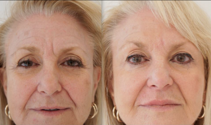 Омоложение до после