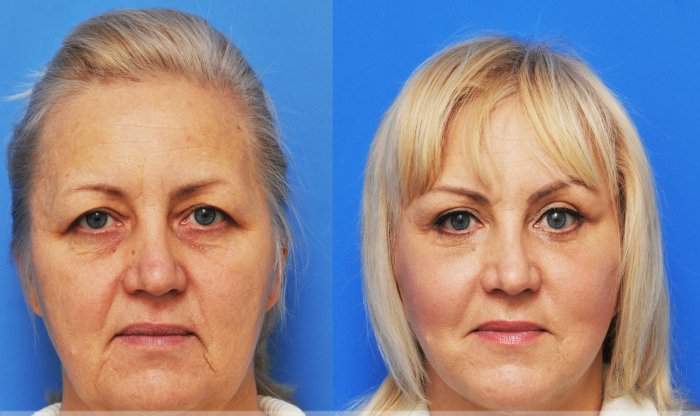 Обвисшее лицо