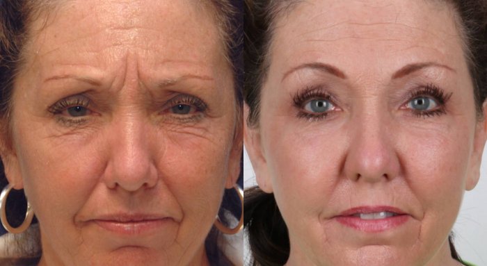 Инъекции гиалуроновой кислоты до и после