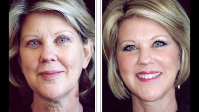 Уколы гиалуроновой