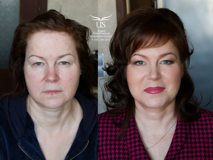 Уколы ботокса до и после