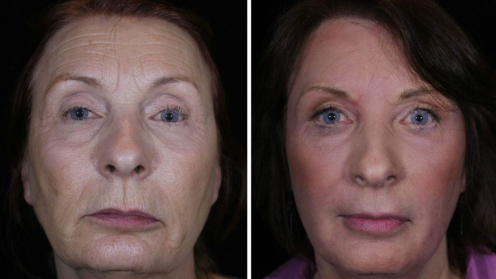 Овал лица после 50