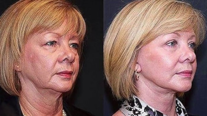 Микротоки для лица до и после