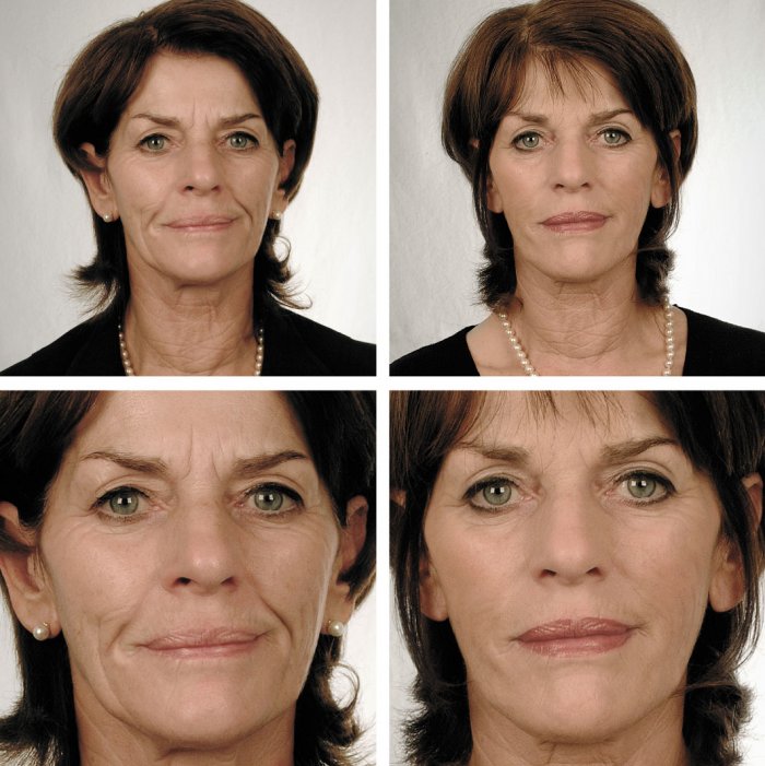 Гиалурон уколы