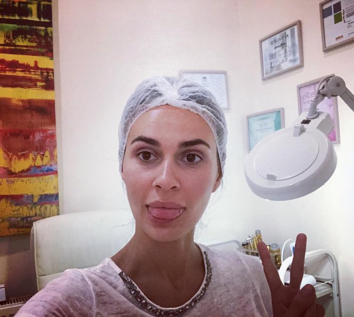 До и после пластики лица