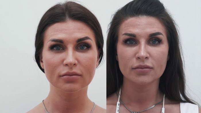 Омоложение лица до и после