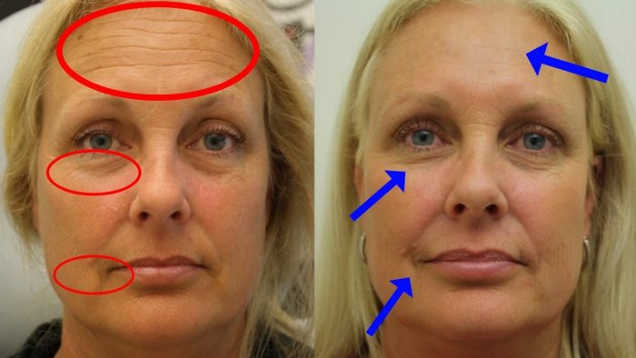 Морщины до и после