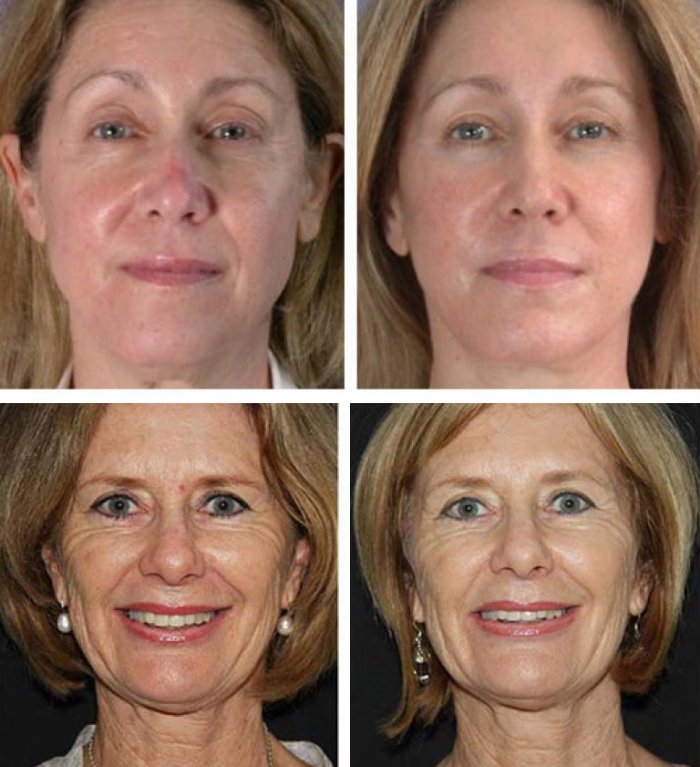 Девушка уколы красоты