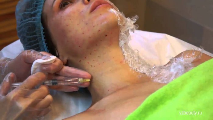 Плазмолифтинг лица точки