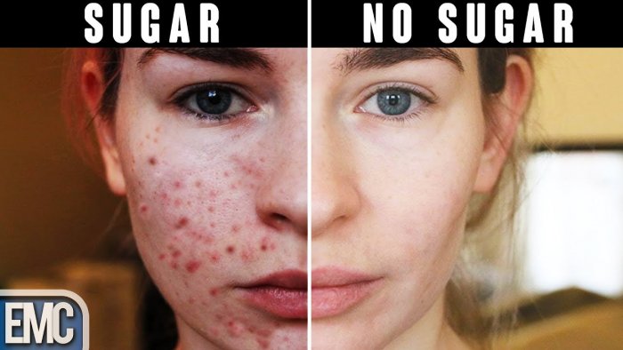 Плазмолифтинг от постакне