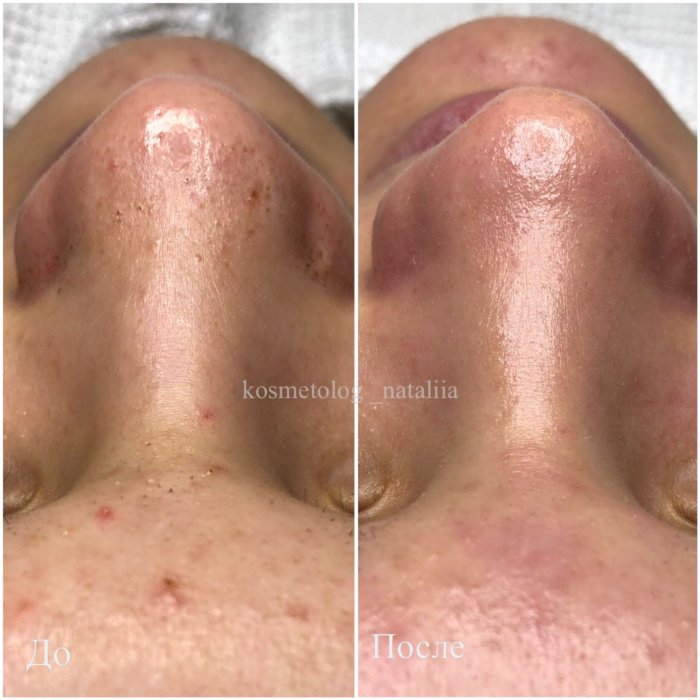 Плазмолифтинг от постакне