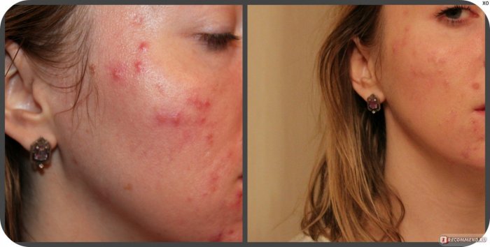 Плазмолифтинг для лица постакне