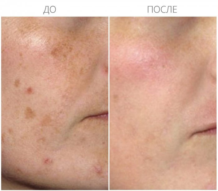 Псориаз на лице начальная стадия