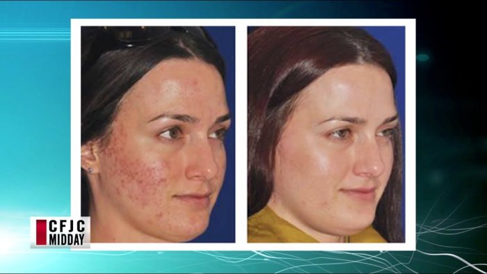 Плазмолифтинг от постакне