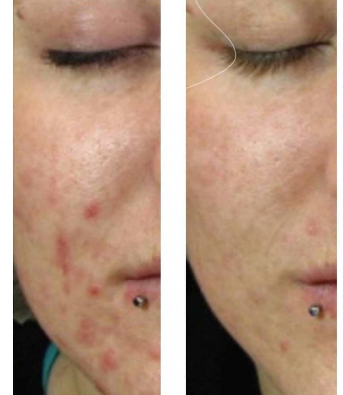 Плазмолифтинг от постакне