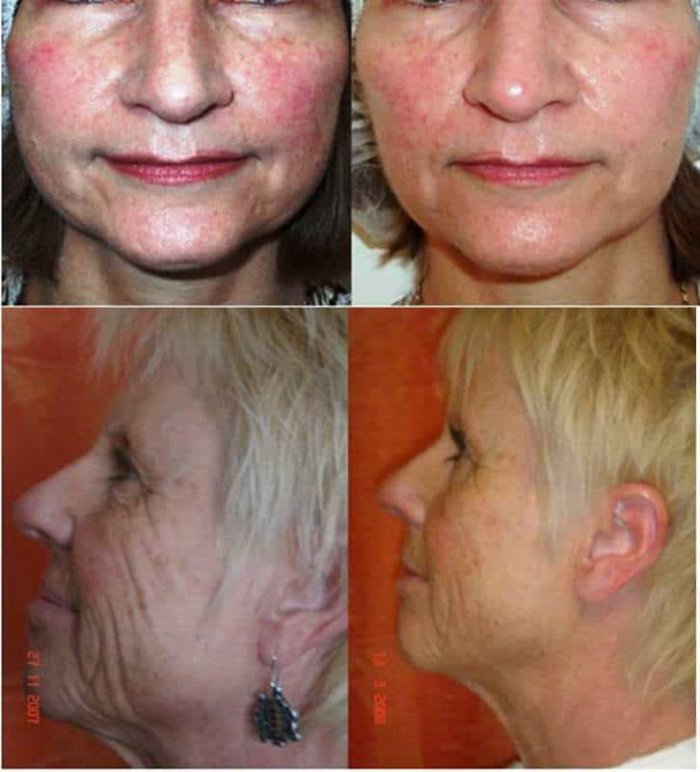 Лицо после плазмолифтинга