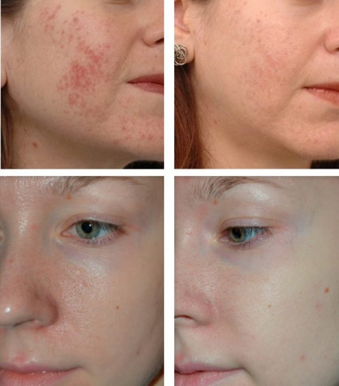 Убирание прыщей до после