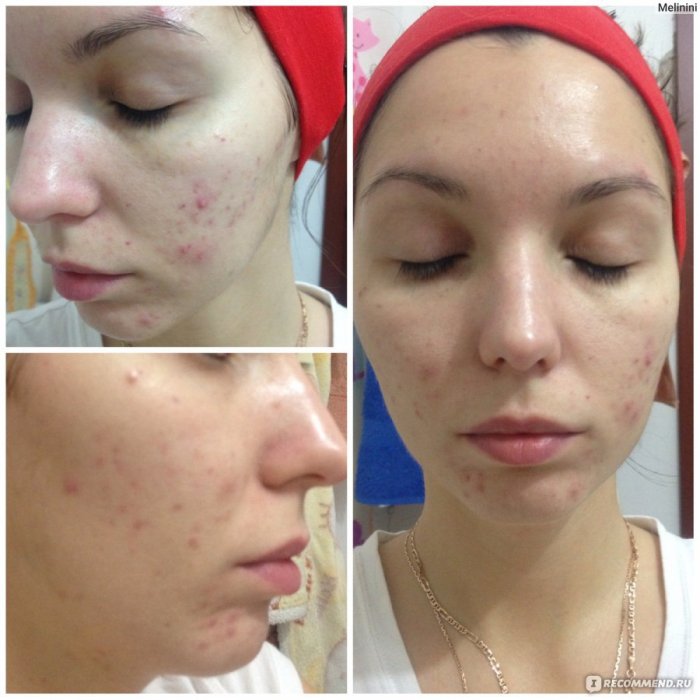 Плазмолифтинг для лица прыщи