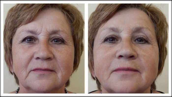 Плазмотерапия лица до и после