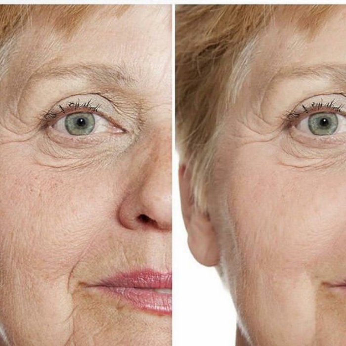 Плазмолифтинг лица до и после