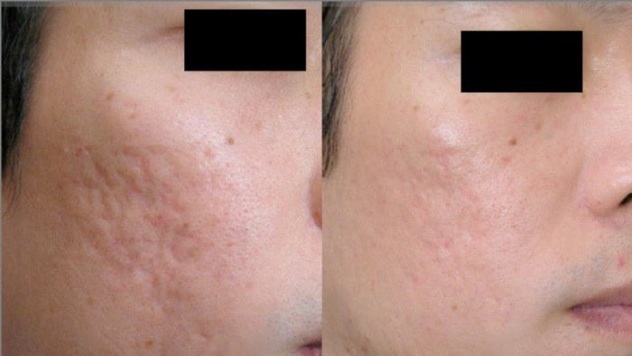 Плазмотерапия для лица до и после пост акне