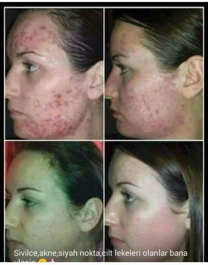 Плазмолифтинг для лица постакне