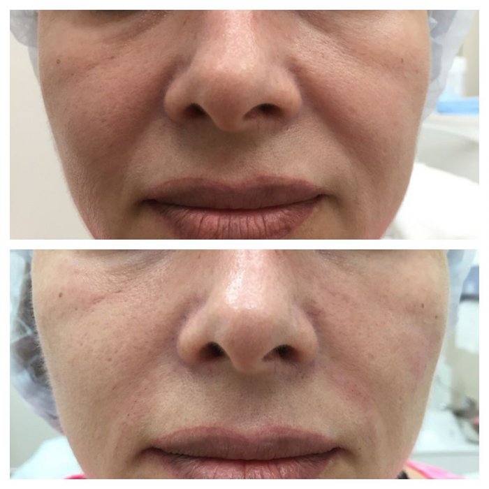 Мезотерапия лица носогубные складки