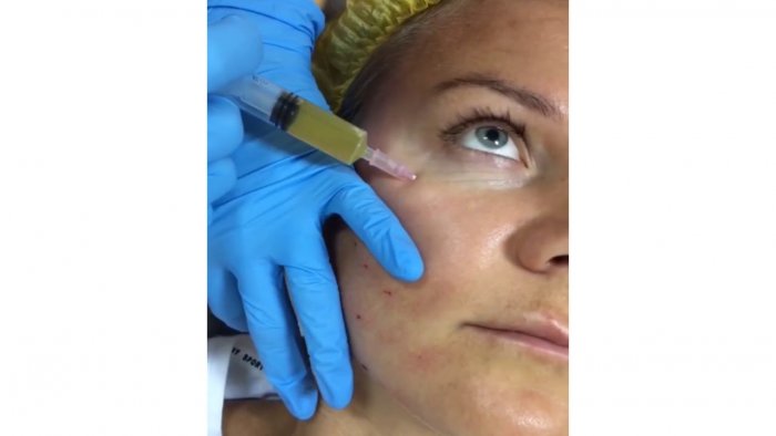 Плазмолифтинг от постакне