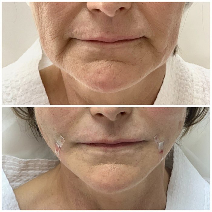 Подтяжка носогубных складок