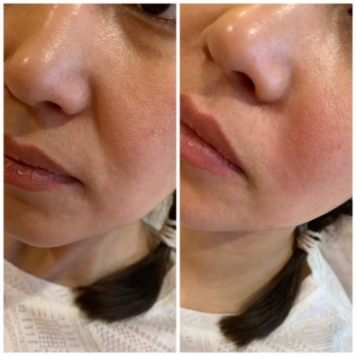 Носогубные складки до и после филлера