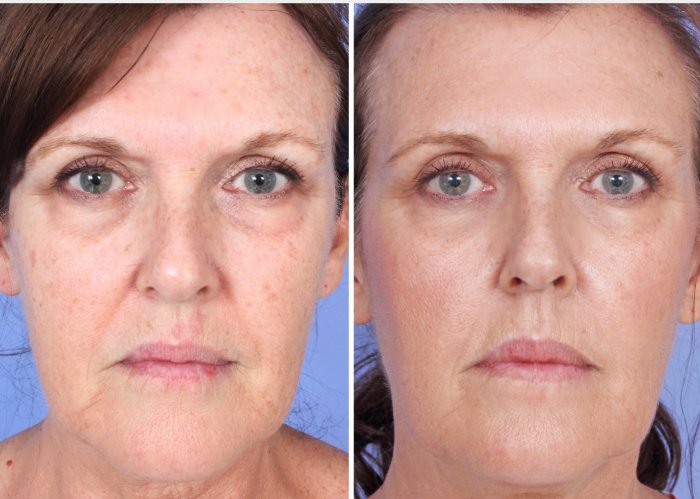 Плазмолифтинг до и после