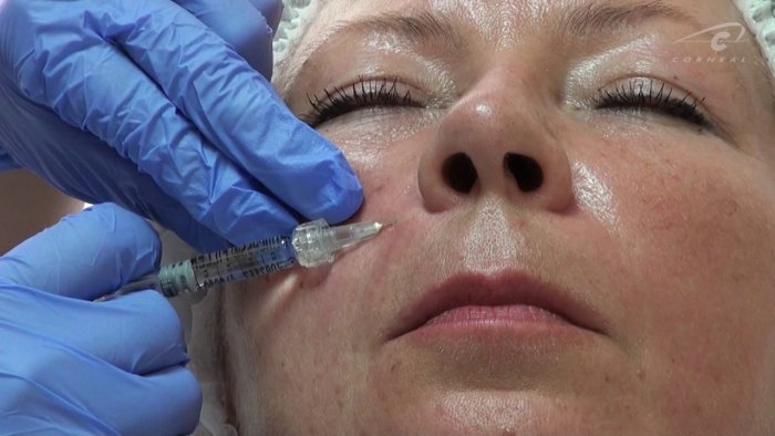 Ринопластика носогубных складок