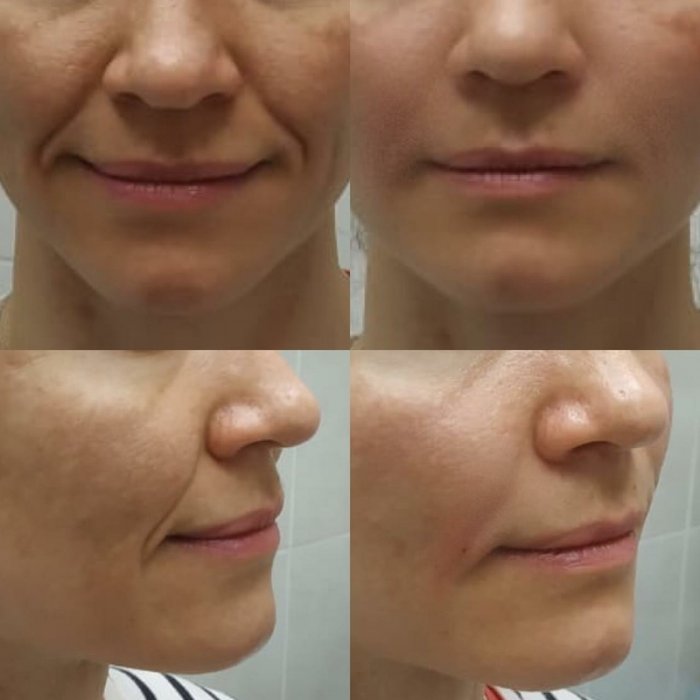 Носогубные складки при улыбке