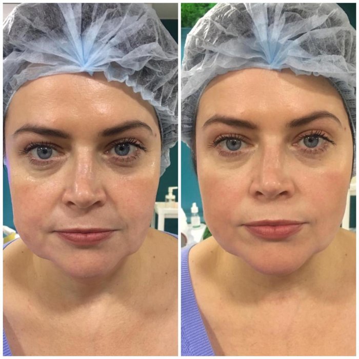 Плазмолифтинг лица до и после